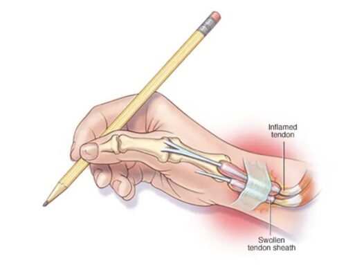 Got Thumb Pain? Here’s How Osteopathy Can Help with De Quervain’s Tenosynovitis